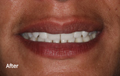 Cosmetic Dentures Before After pictures
